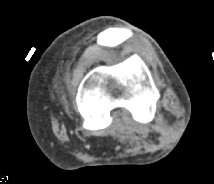 Occlusion of the Popliteal Artery - CTisus CT Scan