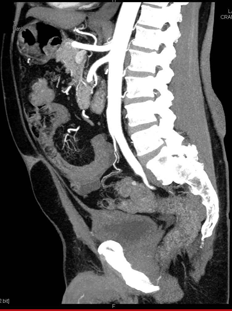 Superior Mesenteric Artery (SMA) Occlusion - CTisus CT Scan