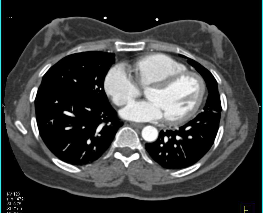 Vascular Map Without Active Bleed - CTisus CT Scan