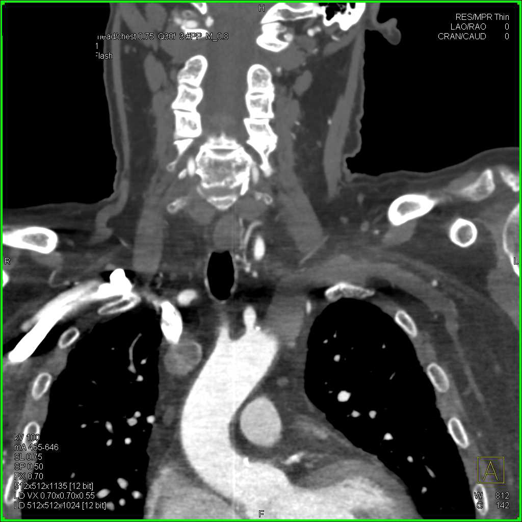 Left Subclavian Artery Occlusion - CTisus CT Scan