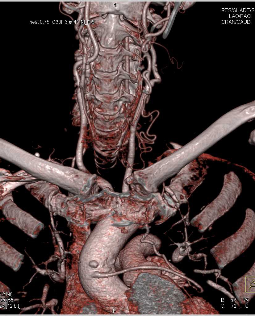 CTA Neck and Arch - CTisus CT Scan