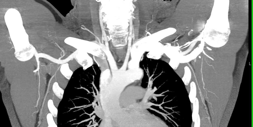 Occlusion Left Subclavian Artery - CTisus CT Scan