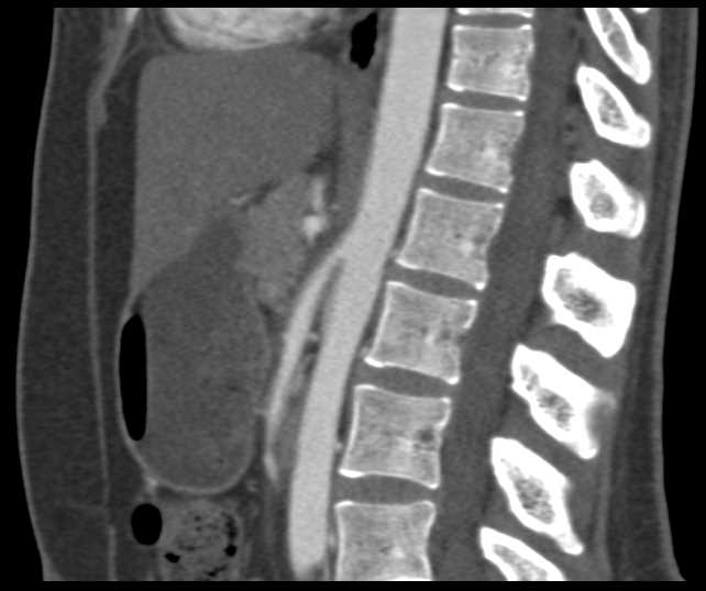 Mesenteric Vascular Mapping - CTisus CT Scan