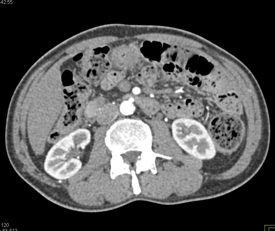 Pseudo clot due to Timing in the Inferior Vena Cava (IVC) - CTisus CT Scan