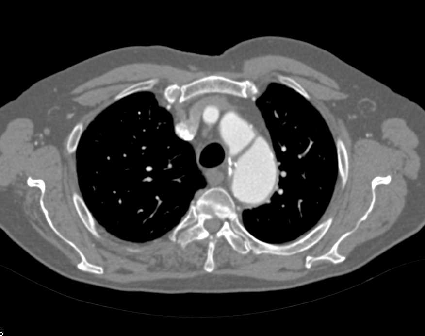 Dissection in a Patient with Vasculitis - CTisus CT Scan