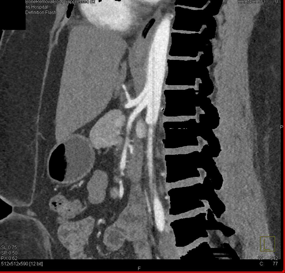 Dual Energy Bone Removal and Vascular Map - CTisus CT Scan