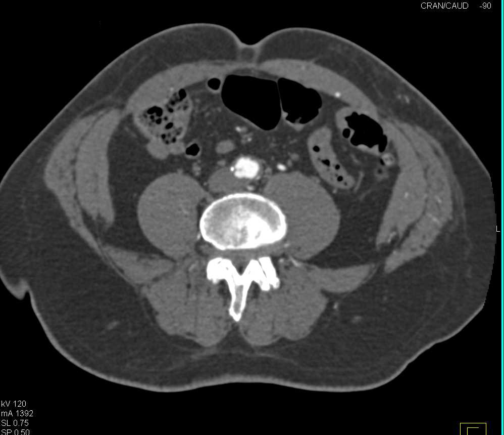 Occlusion of the Left Common Iliac Artery - CTisus CT Scan