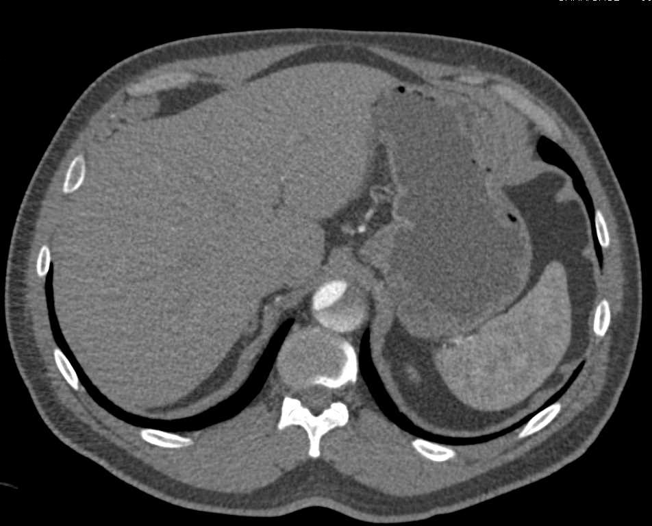 Ehlers-Danlos Syndrome with Multiple Aneurysms Including Left Popliteal Artery - CTisus CT Scan