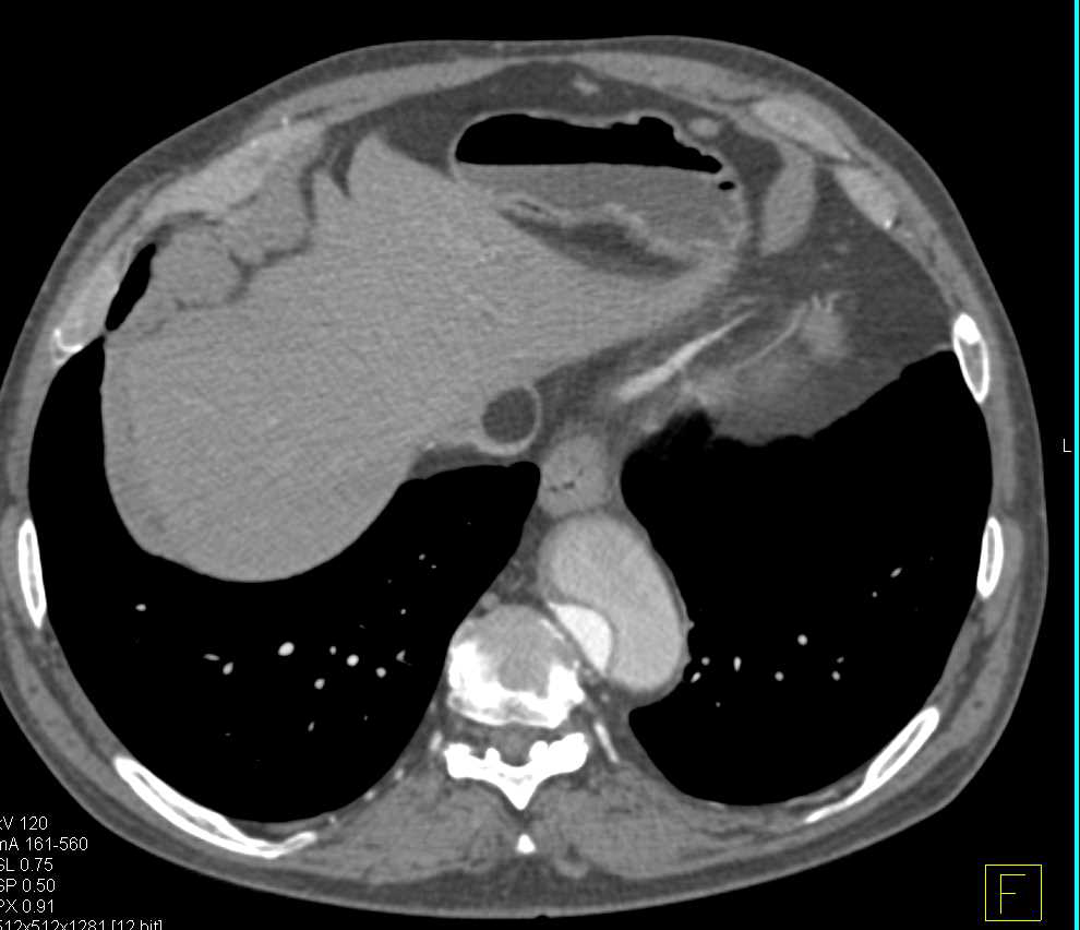 Type A Dissection with Repair - CTisus CT Scan