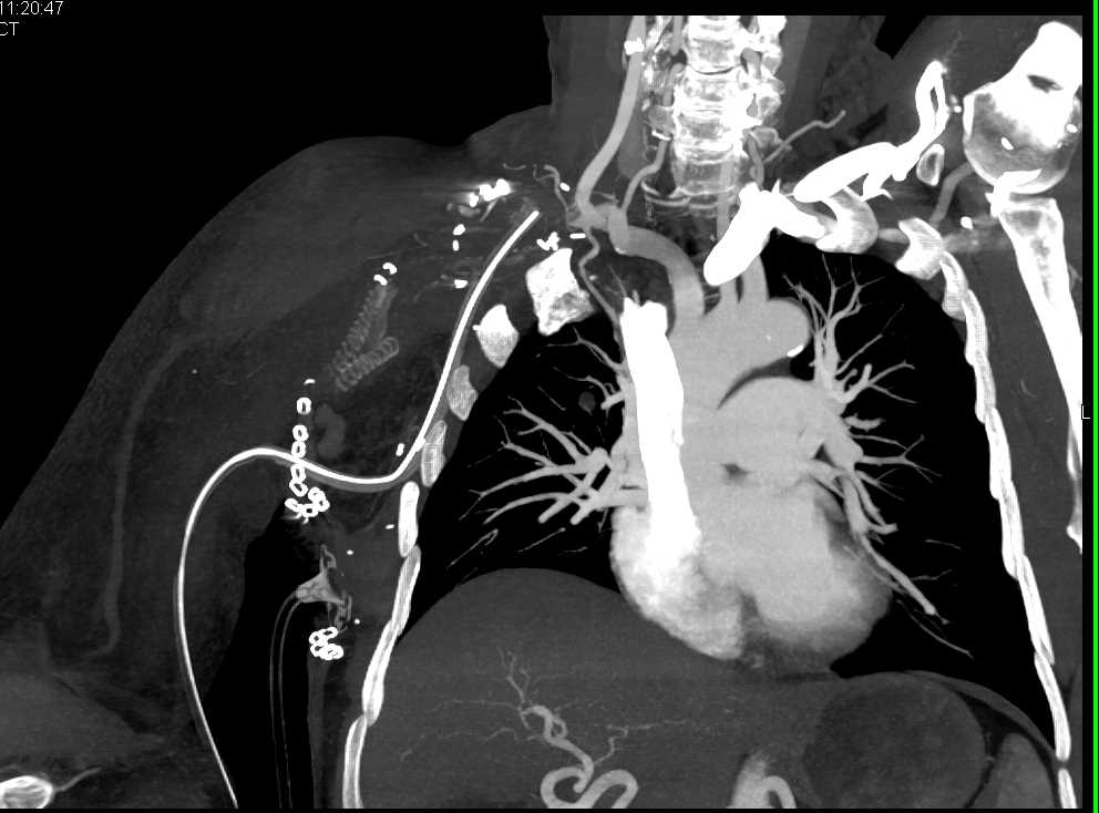 Multiple Vascular Grafts are Occluded - CTisus CT Scan