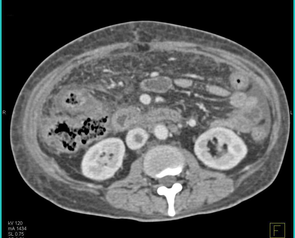 Inferior Vena Cava (IVC) Clot and Ascites - CTisus CT Scan