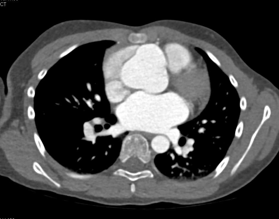 Dilated Aortic Root - CTisus CT Scan