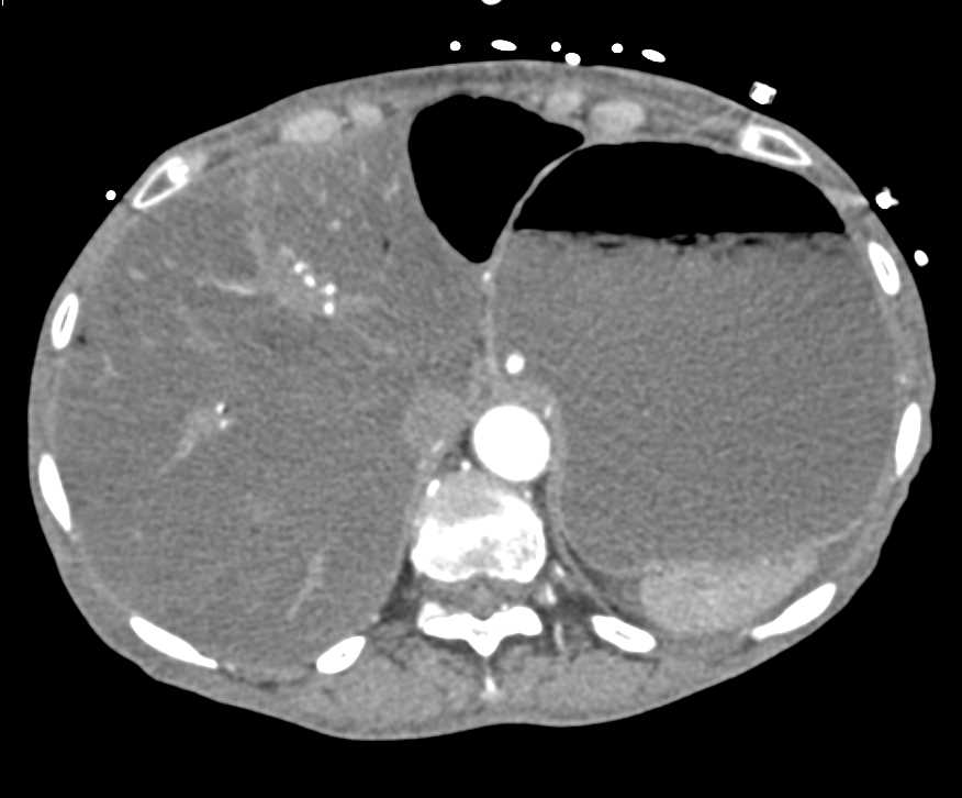 Narrowed Celiac Artery and Ischemic Bowels Changes - CTisus CT Scan