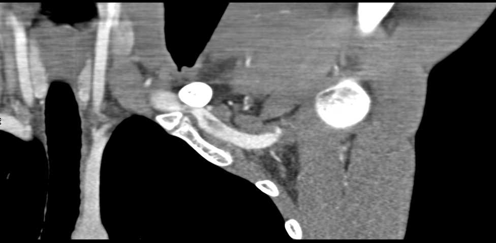 Focal Dissection in Left Axillary Artery - CTisus CT Scan