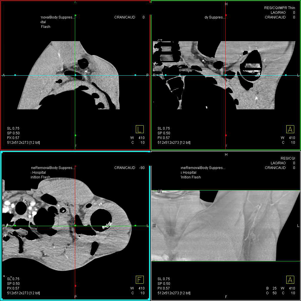 Focal Dissection in Left Axillary Artery and Compression by Rib - CTisus CT Scan