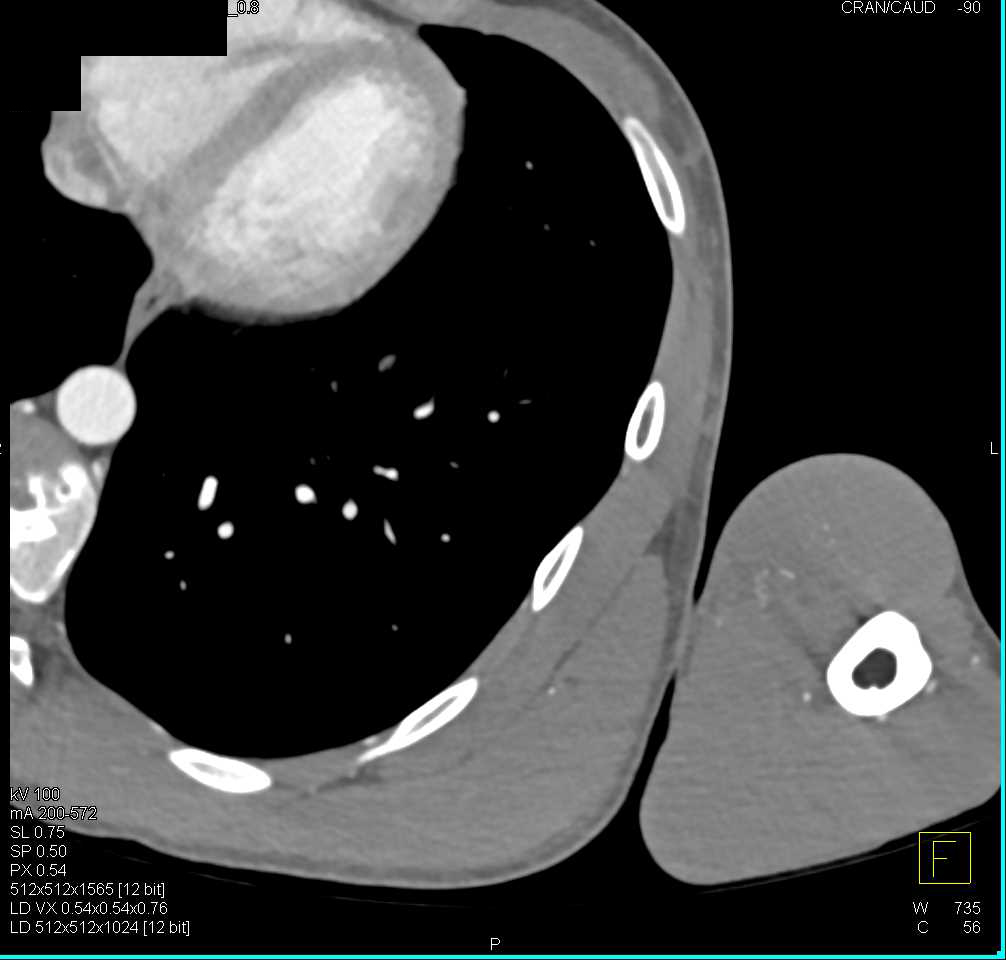 Focal Dissection in Left Axillary Artery and Compression by Rib - CTisus CT Scan