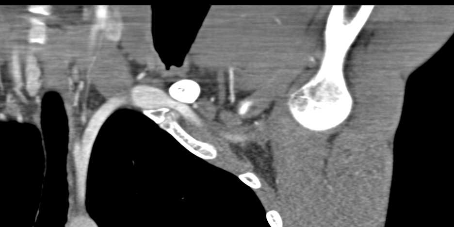 Left Subclavian Artery Aneurysm - CTisus CT Scan