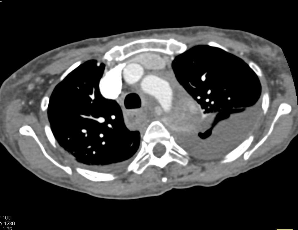 Type B Dissection - CTisus CT Scan