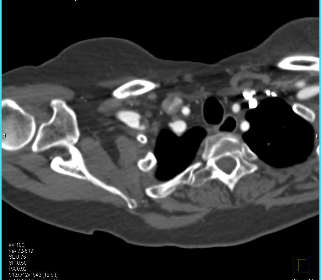 Right Axillary Artery Aneurysm - CTisus CT Scan