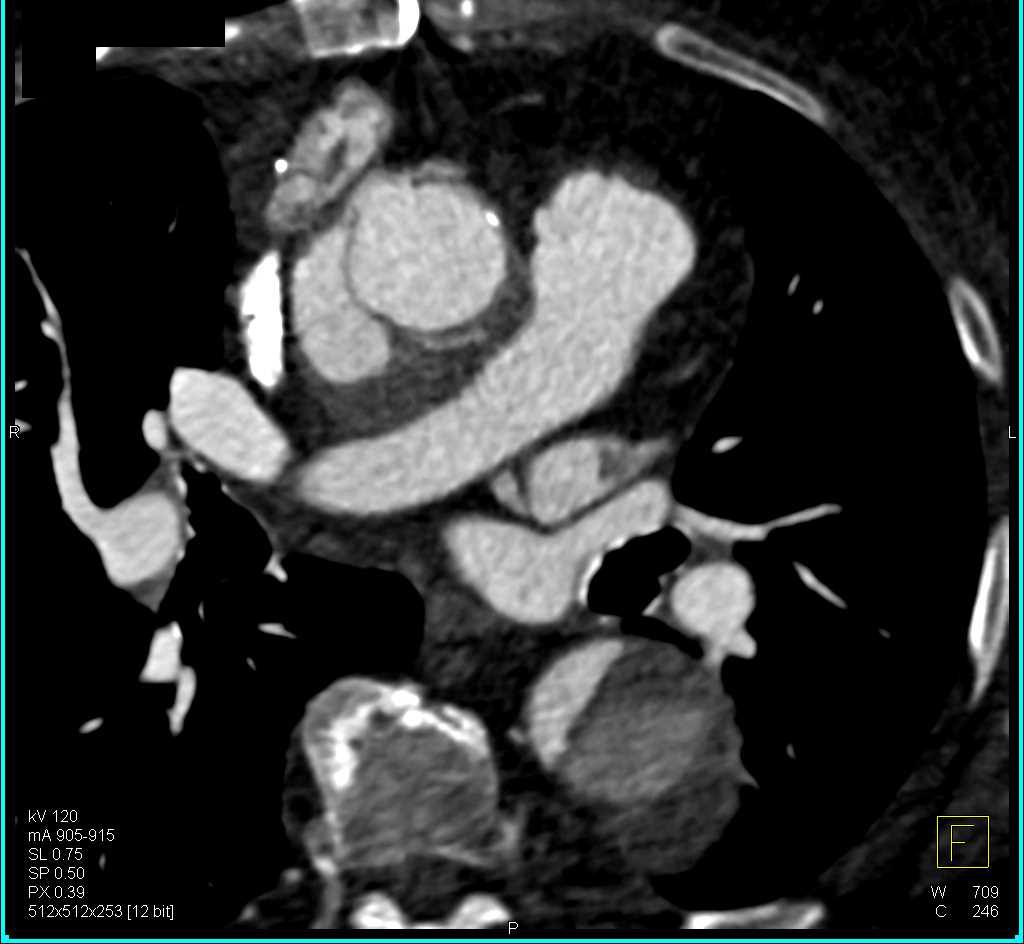 Aortic Dissection with Thrombus in the Atrial Appendage - CTisus CT Scan