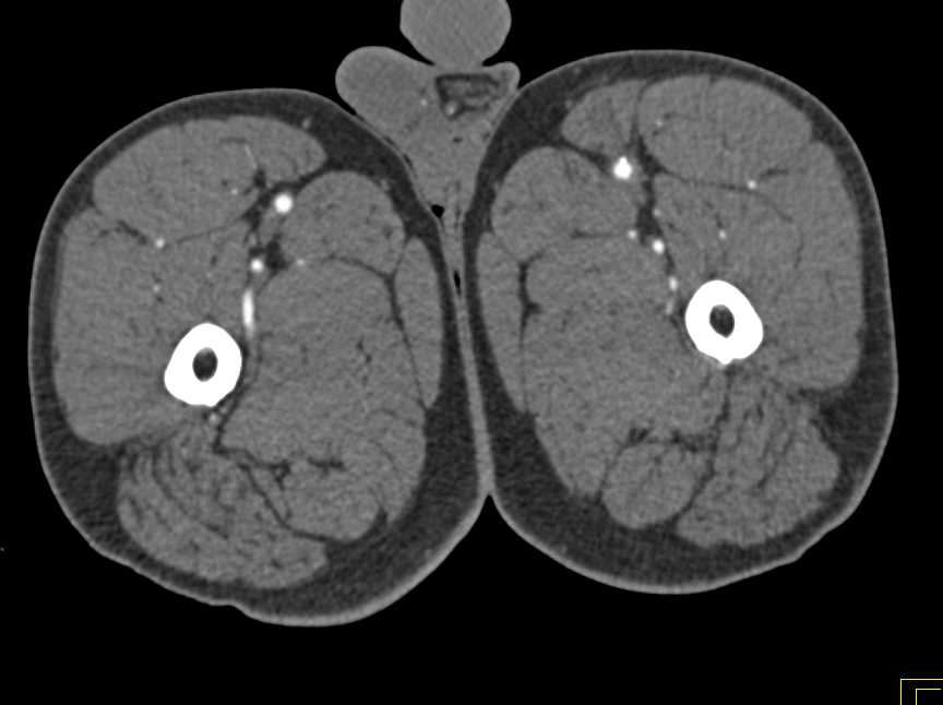 Peripheral Vascular Disease with Left Popliteal Artery Occluded - CTisus CT Scan