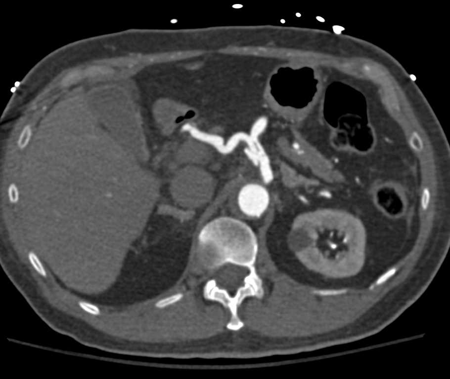 Celiac Artery Dissection in patient with Vasculitis - CTisus CT Scan