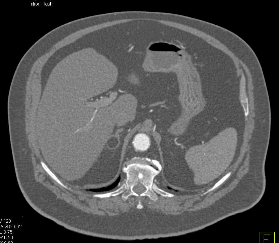 Bilateral Adrenal Myelolipomas in Patient with Aortic Root Repair - CTisus CT Scan