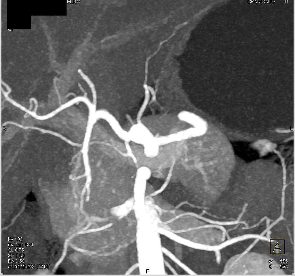 Normal Celiac and Superior Mesenteric Artery (SMA) Anatomy - CTisus CT Scan