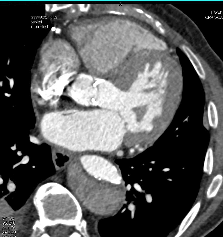 Pseudoaneurysm of the Ascending Aorta S/P Repair - CTisus CT Scan