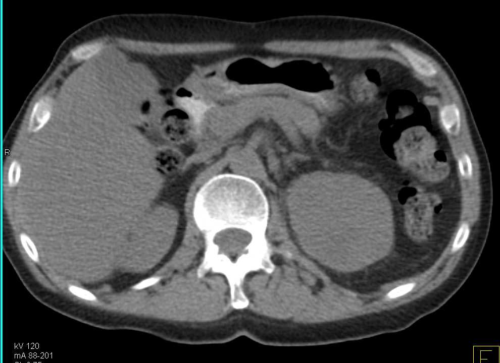 Adrenal Carcinoma Invades the Inferior Vena Cava (IVC) - CTisus CT Scan