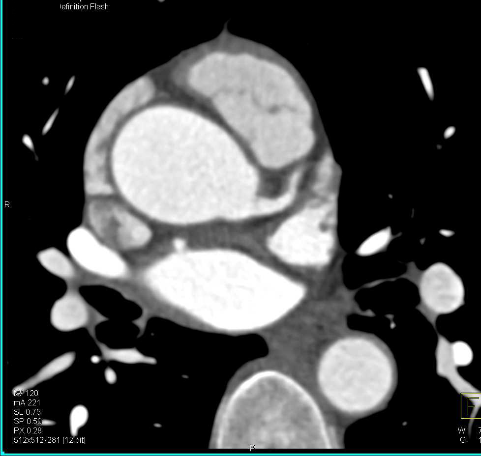 Dilated Aortic Root with Left Anterior Descending Coronary Artery (LAD) Disease - CTisus CT Scan