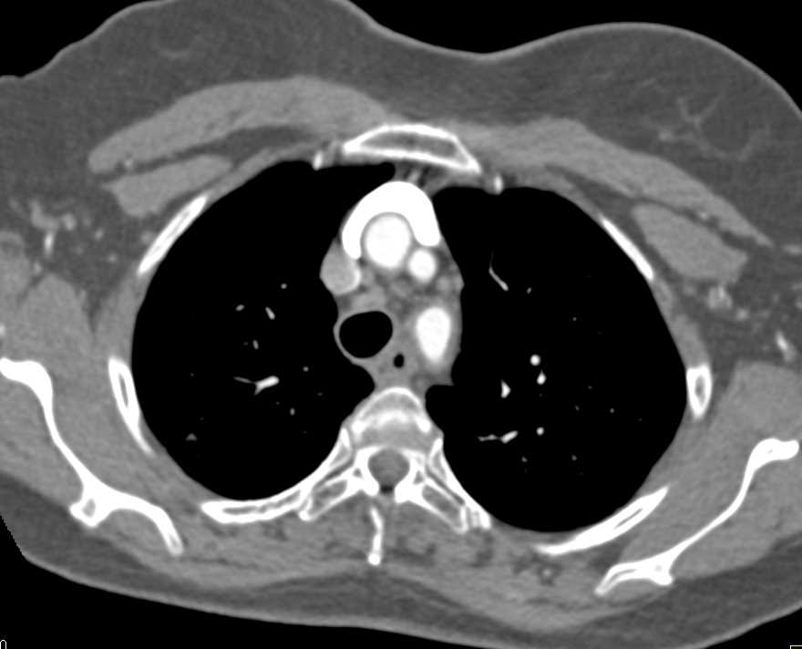 Loeys-Dietz Without Dissection - CTisus CT Scan