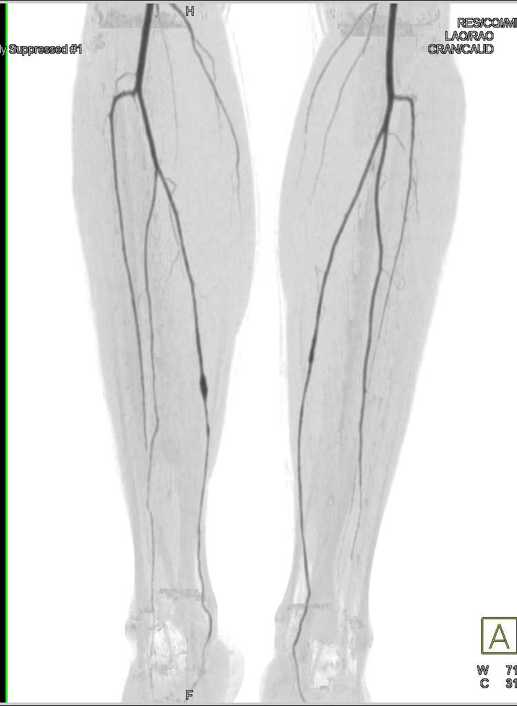 Focal Aneurysm Right Posterior Tibial Artery in Ehlers-Danlos Patient - CTisus CT Scan