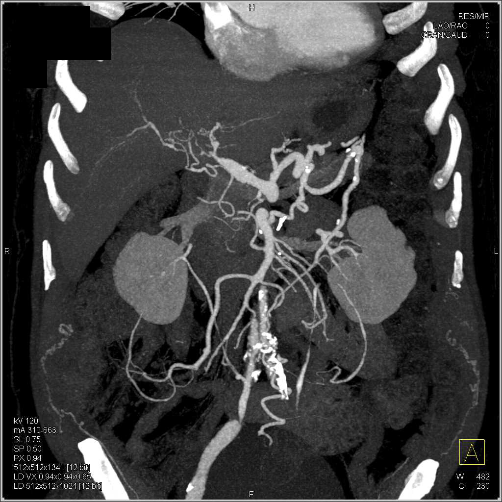 Hepatic Artery Aneurysm with Vasculitis - CTisus CT Scan