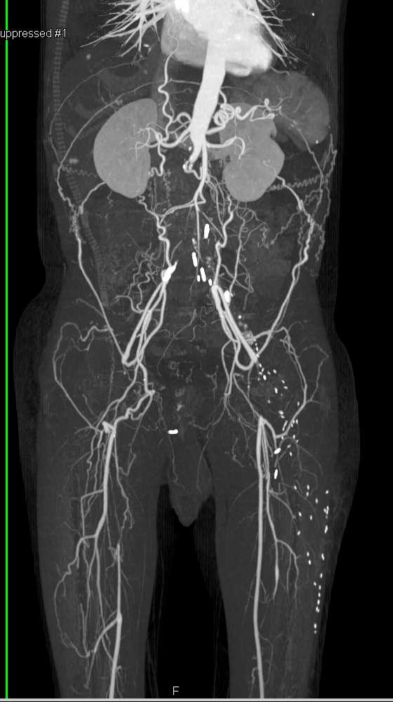 Aortic Occlusion with Collateral Pathways - CTisus CT Scan