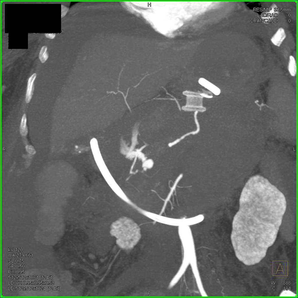 Active Bleed of Branch off the Gastroduodenal Artery (GDA) with Hemoperitoneum - CTisus CT Scan