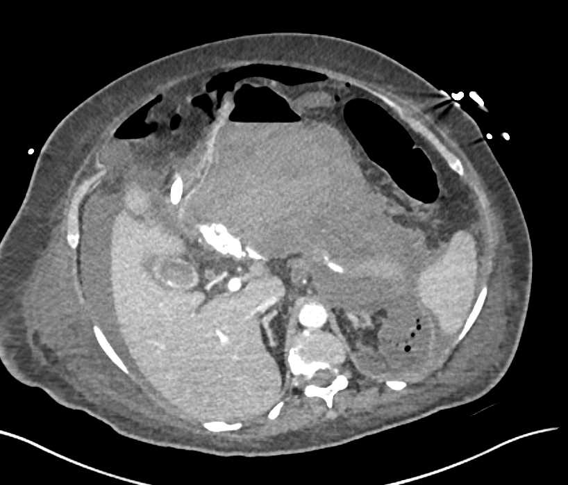 Active Bleed of Branch off the Gastroduodenal Artery (GDA) with Hemoperitoneum - CTisus CT Scan