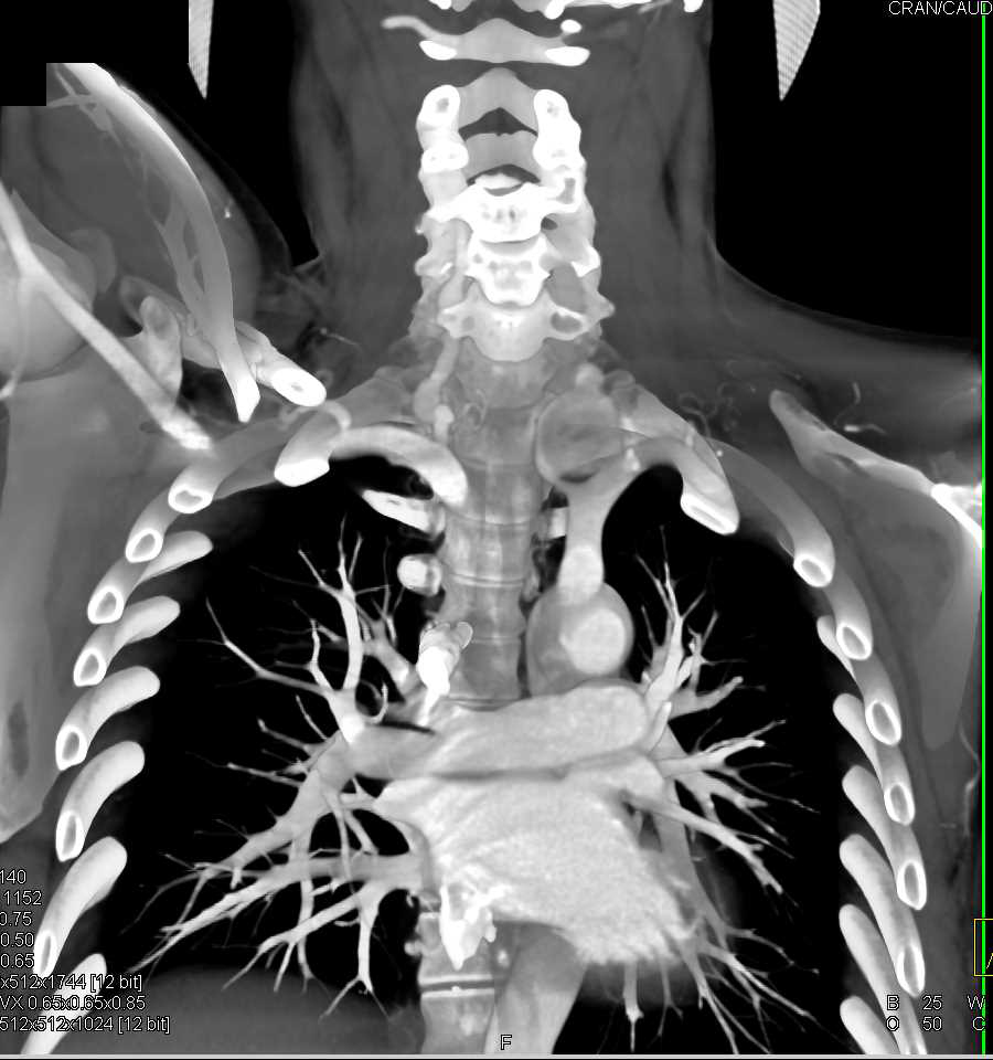 Ehlers-Danlos Syndrome with Vascular Abnormalities Involving the Mesenteric Vasculature - CTisus CT Scan