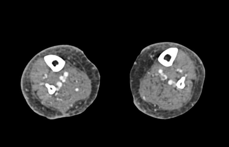 CTA Runoff with Early Venous Filling - CTisus CT Scan