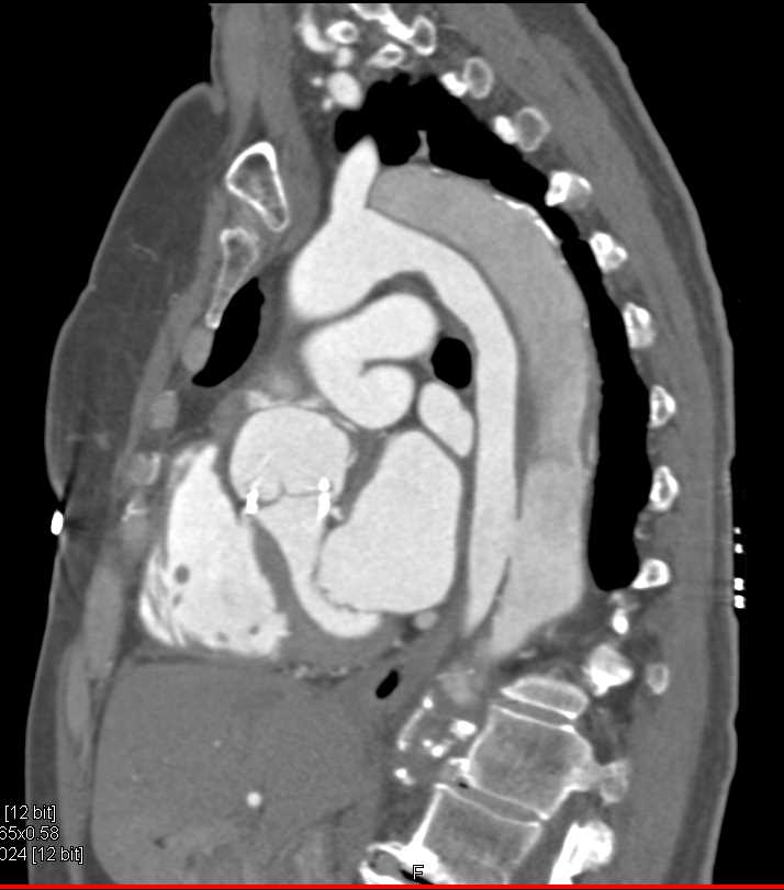 Type B Dissection - CTisus CT Scan