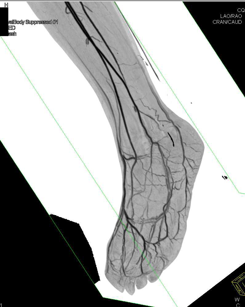 Normal CTA Runoff with Bone Removal - CTisus CT Scan