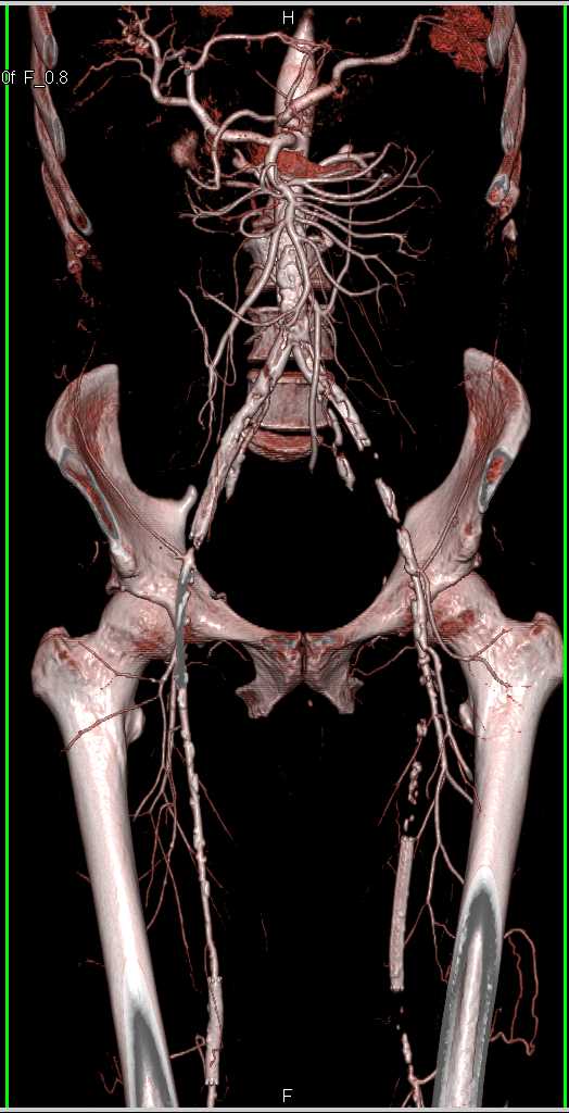 CTA Runoff with Multiple Left Sided Occlusions Nicely Show on VRT and MIP Images - CTisus CT Scan