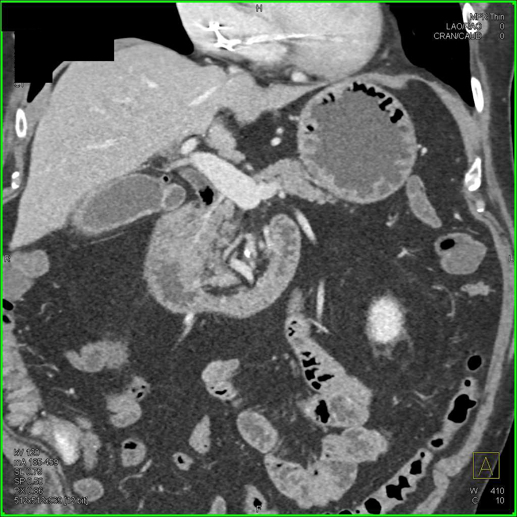 Celiac Artery Occlusion with Flow Through the Gastroduodenal Artery (GDA) to Hepatic Artery - CTisus CT Scan