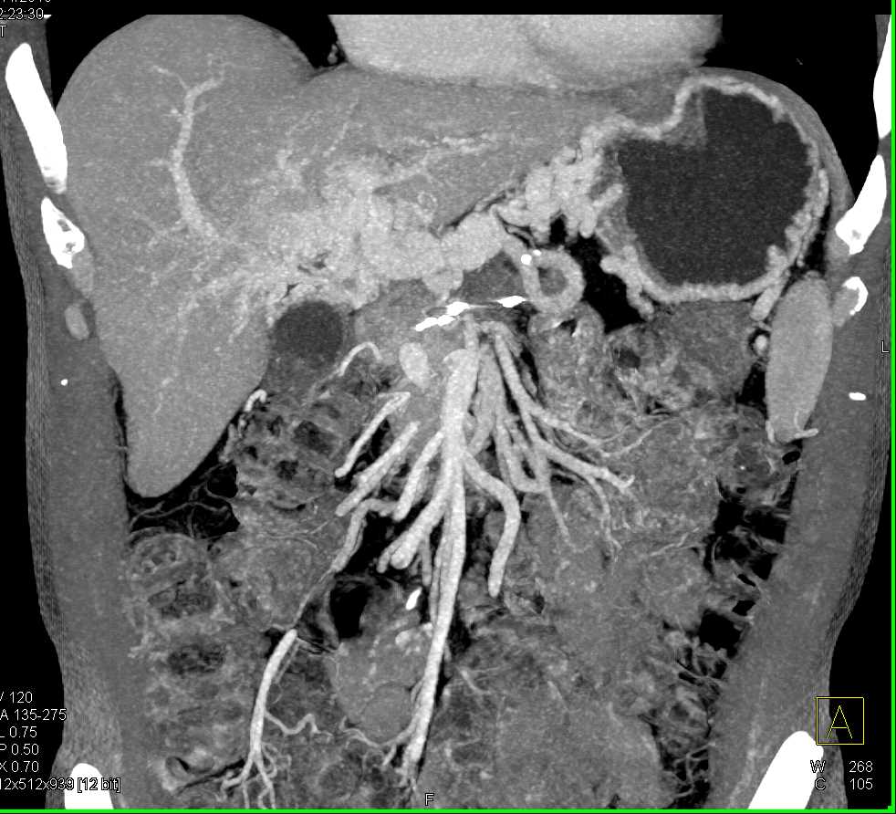 Occluded Portal Vein with Cavernous Transformation of the Portal Vein - CTisus CT Scan