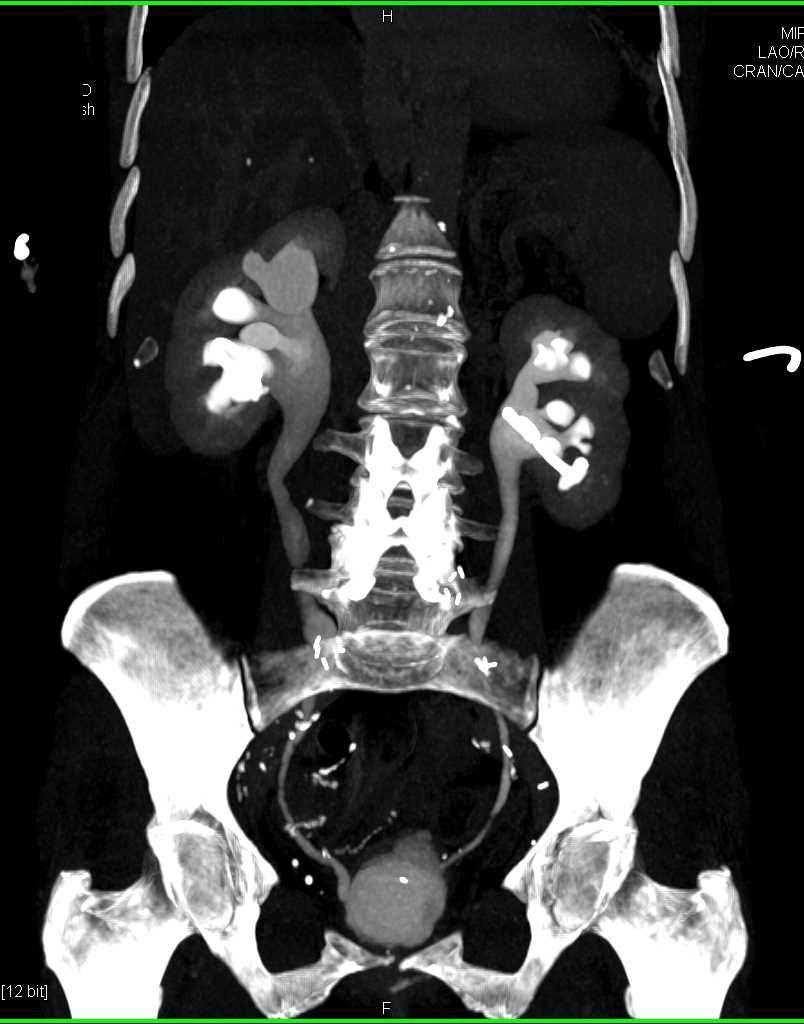 Retroperitoneal Fibrosis Encases the Aorta and Right Iliac Artery - CTisus CT Scan