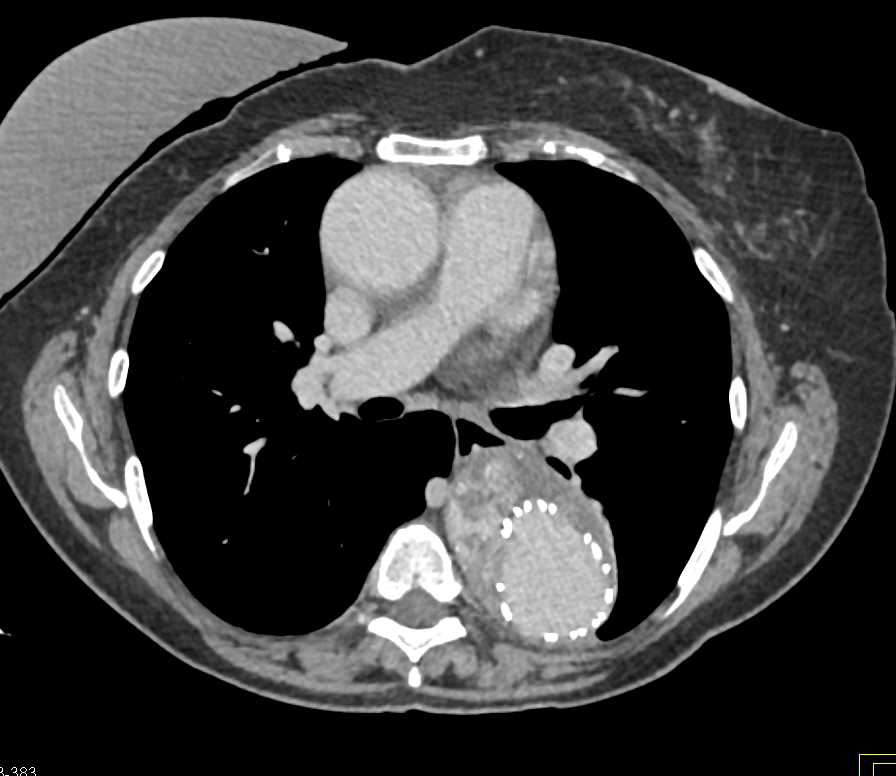 Endovascular Stent with Type 2 Endoleak - CTisus CT Scan