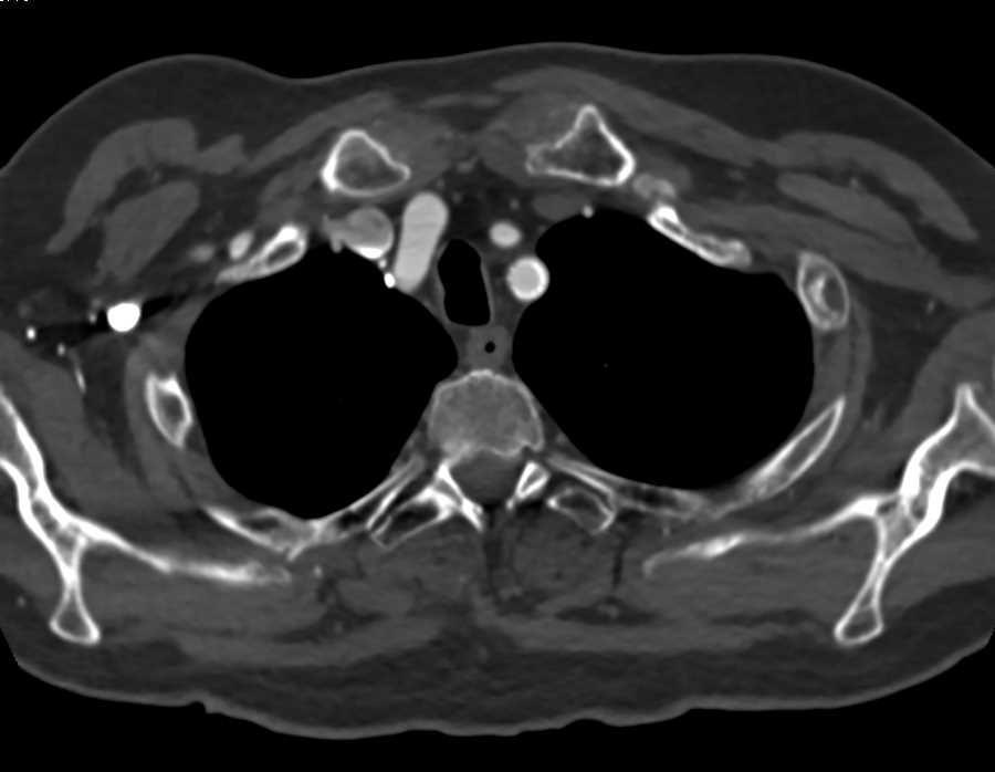 Endovascular Stent with Stent in Left Subclavian Artery - CTisus CT Scan