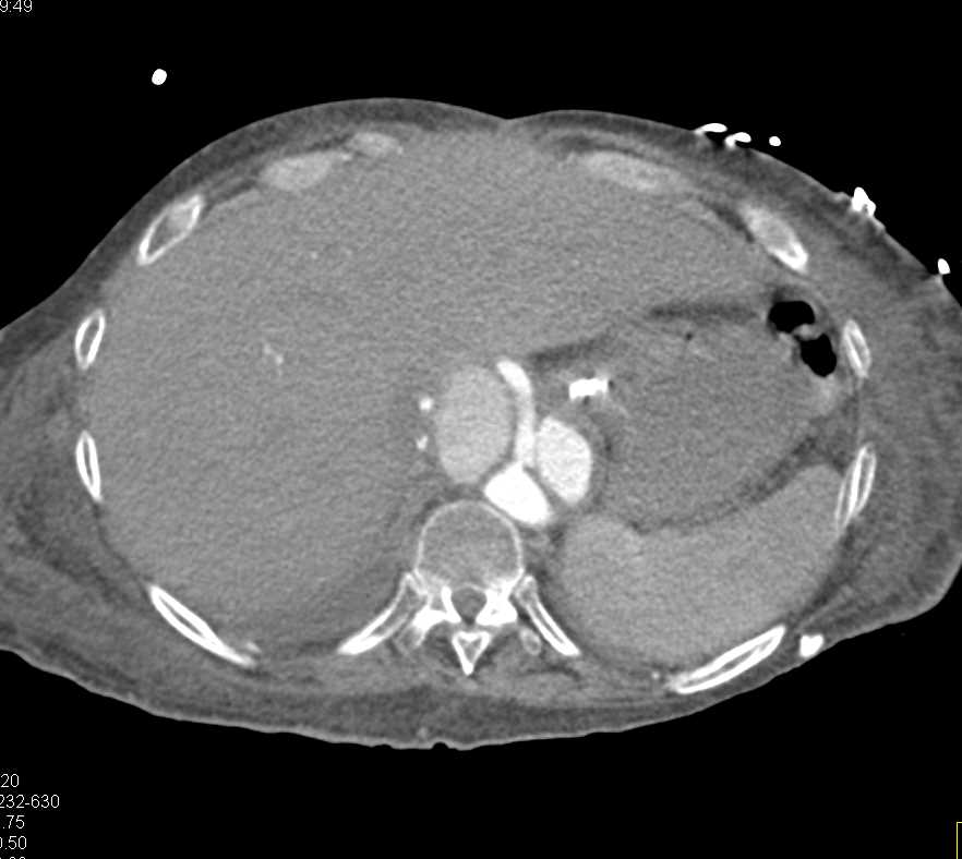 Aortic Dissection with Pseudoaneurysms - CTisus CT Scan