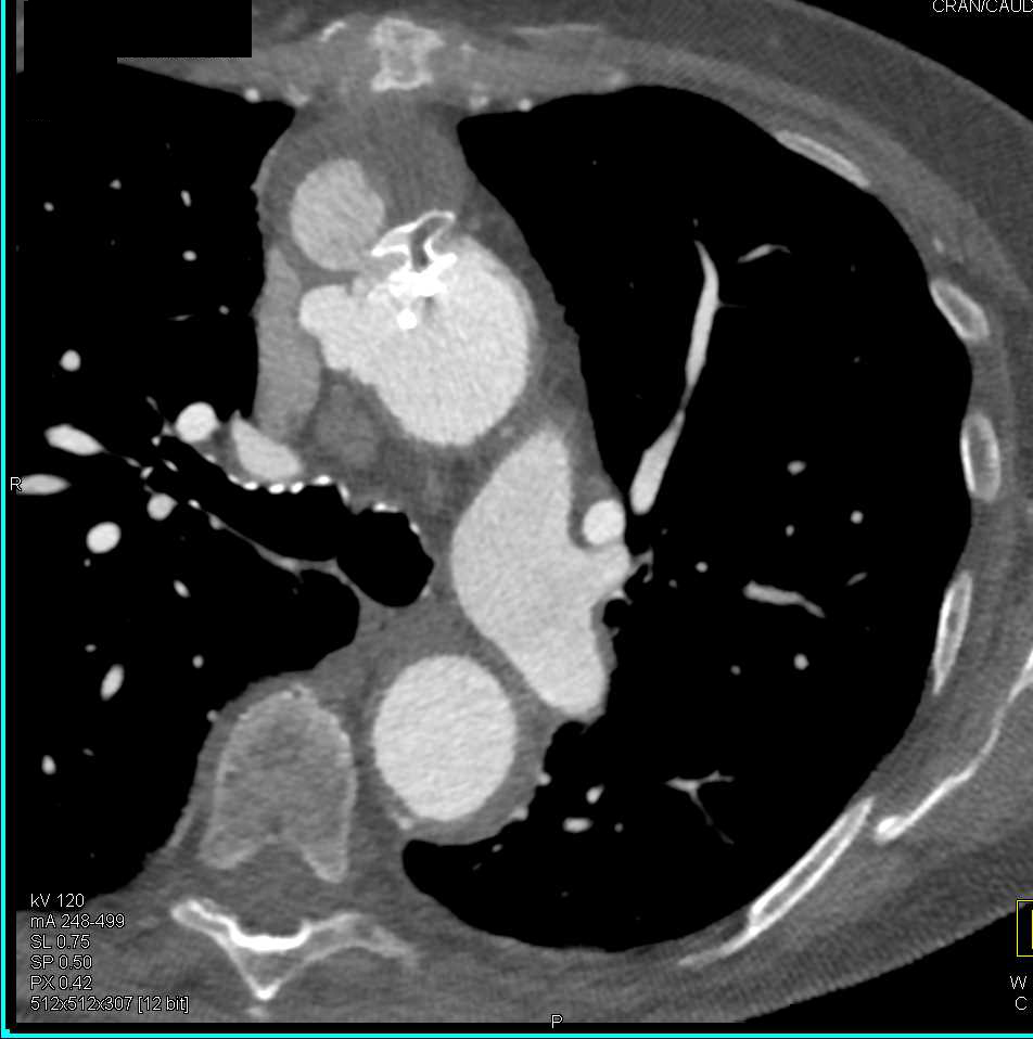 Pseudoaneurysm Ascending Aorta - CTisus CT Scan