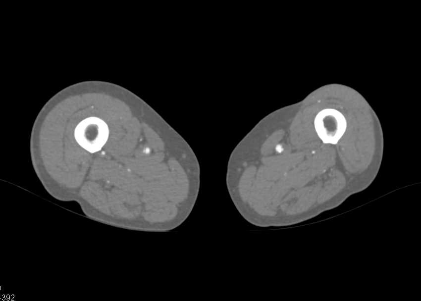 PVD (Peripheral Vascular Disease) with Runoff - CTisus CT Scan